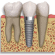 dental implant restoration sarasota