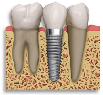dental implant restoration sarasota