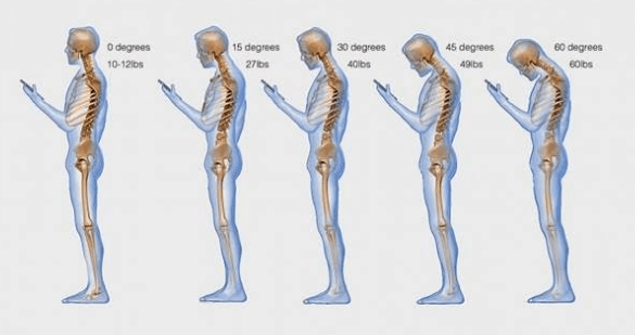 texting causes spinal degeneratio