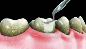 teeth cleaning in sarasota