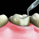 teeth cleaning in sarasota