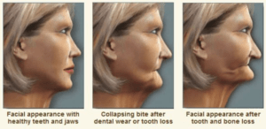 tooth loss and facial changes