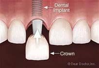 Crown Implant