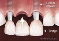 Bridge Implant