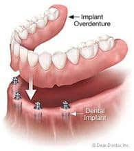 Denture Implant