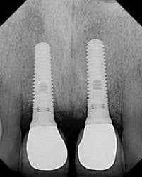 Implant X-ray