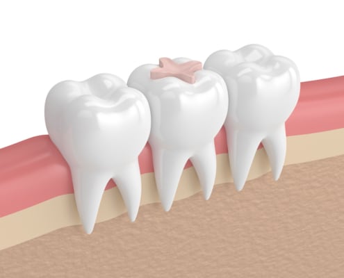 dental inlay