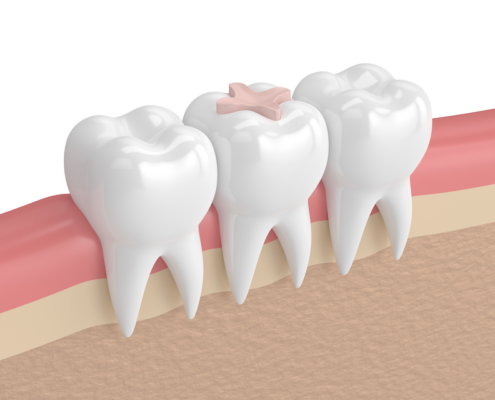 dental inlay