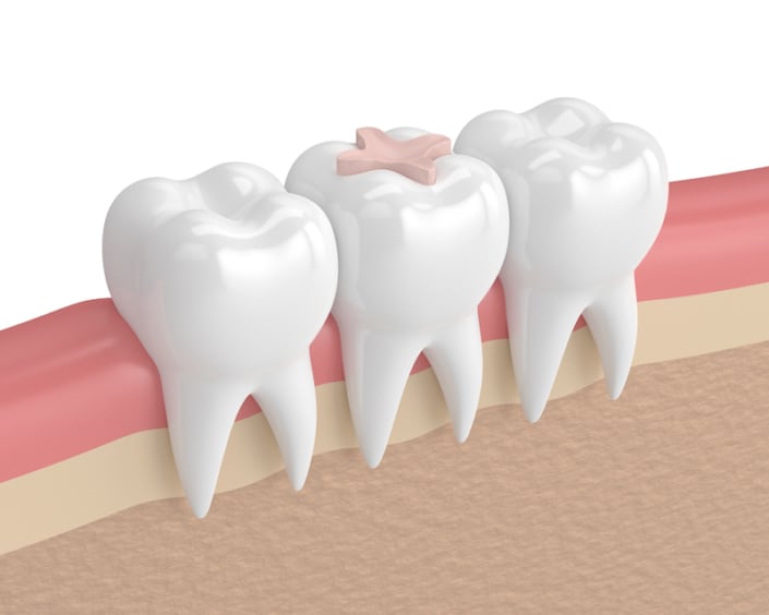 Fill Vs Inlay Inlays VS Onlays, What’s The Difference? - Smile Sarasota