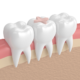 dental inlay