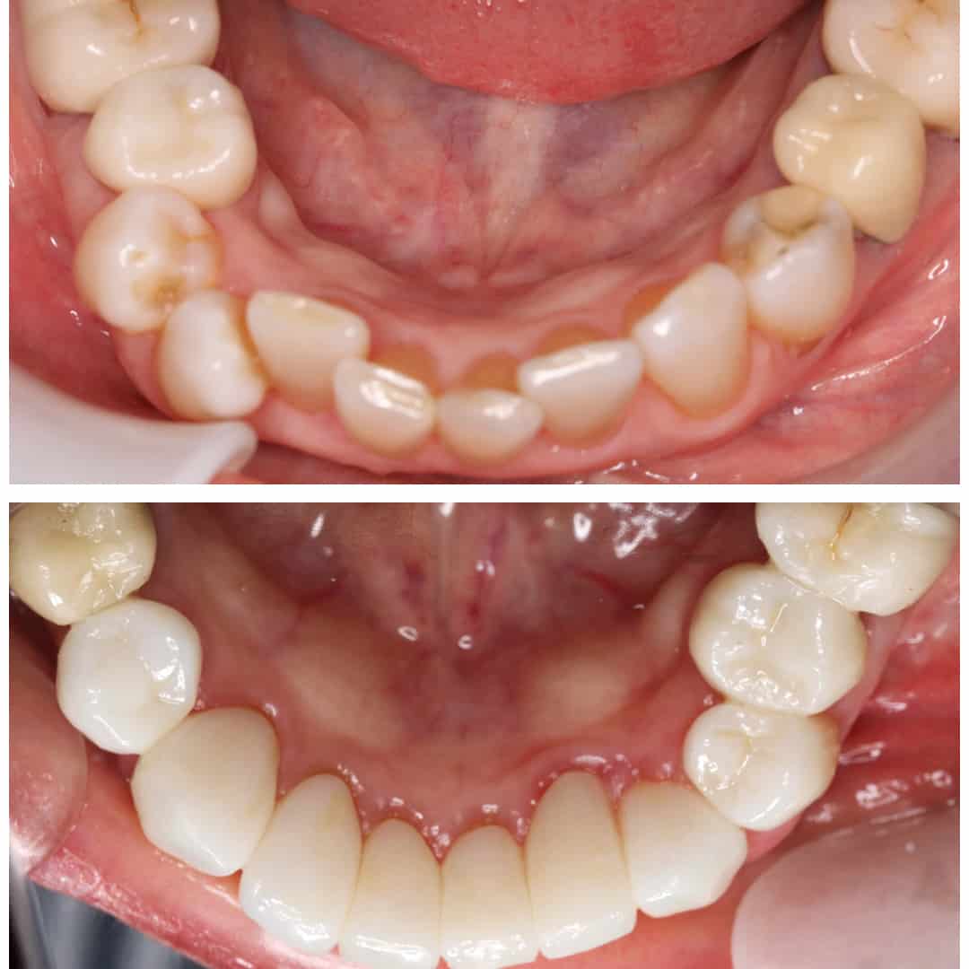 patient-1-before-after-top.jpg