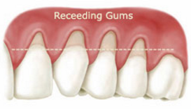 receeding gums