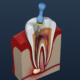 root canal