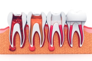 root canal stages