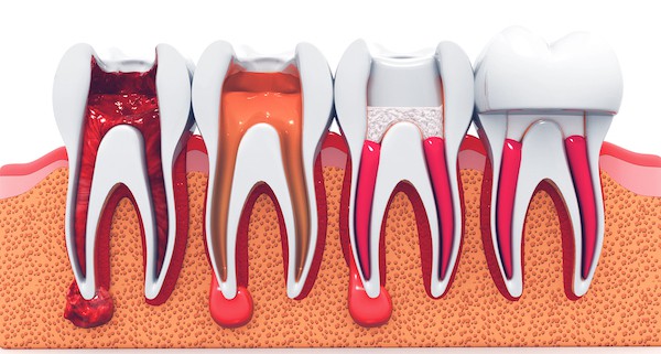 root canal stages